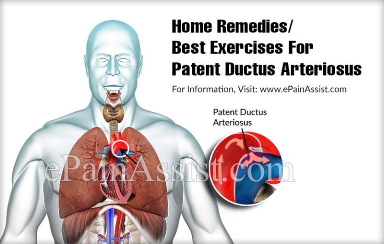 Home Remedies/Best Exercises For Patent Ductus Arteriosus