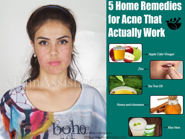 5 Home Remedies for Acne That Actually Work