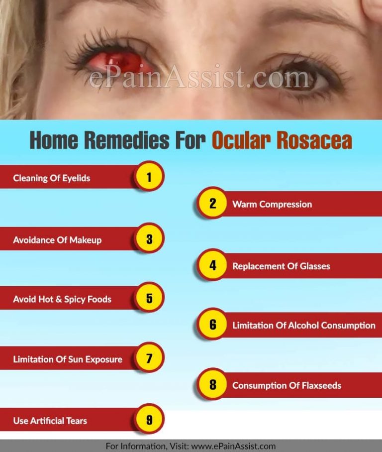 Home Remedies For Ocular Rosacea