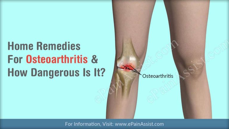 Home Remedies For Osteoarthritis & How Dangerous Is It?
