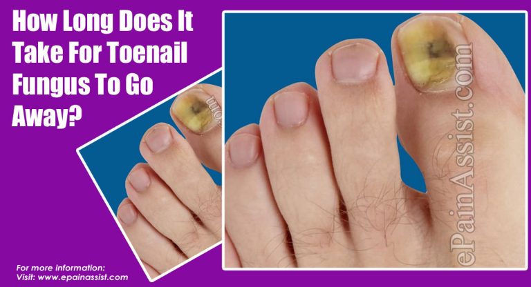 How Long Does It Take For Toenail Fungus To Go Away?