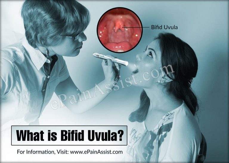 Bifid Uvula: Causes, Treatment, Complications