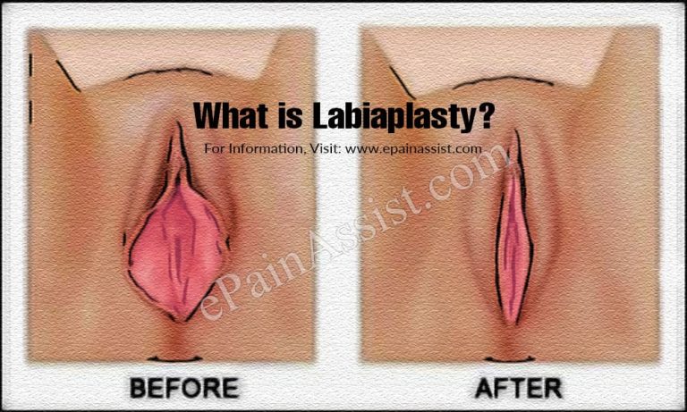 What is Labiaplasty: Procedure, Risks, Complications, Reasons For Going Ahead With Labiaplasty