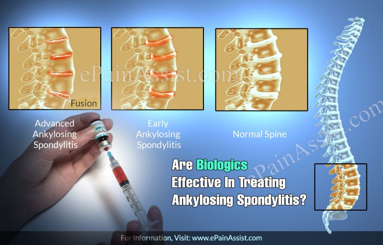 Are Biologics Effective In Treating Ankylosing Spondylitis?