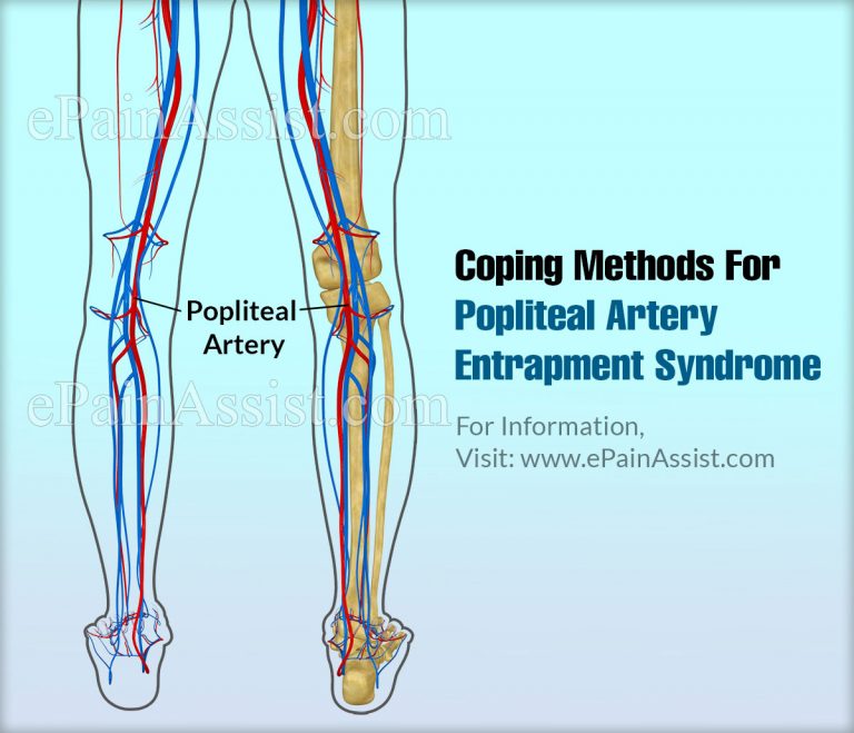 Coping Methods & Home Remedies For Popliteal Artery Entrapment Syndrome