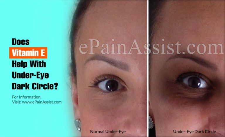 Does Vitamin E Help With Under-Eye Dark Circle?