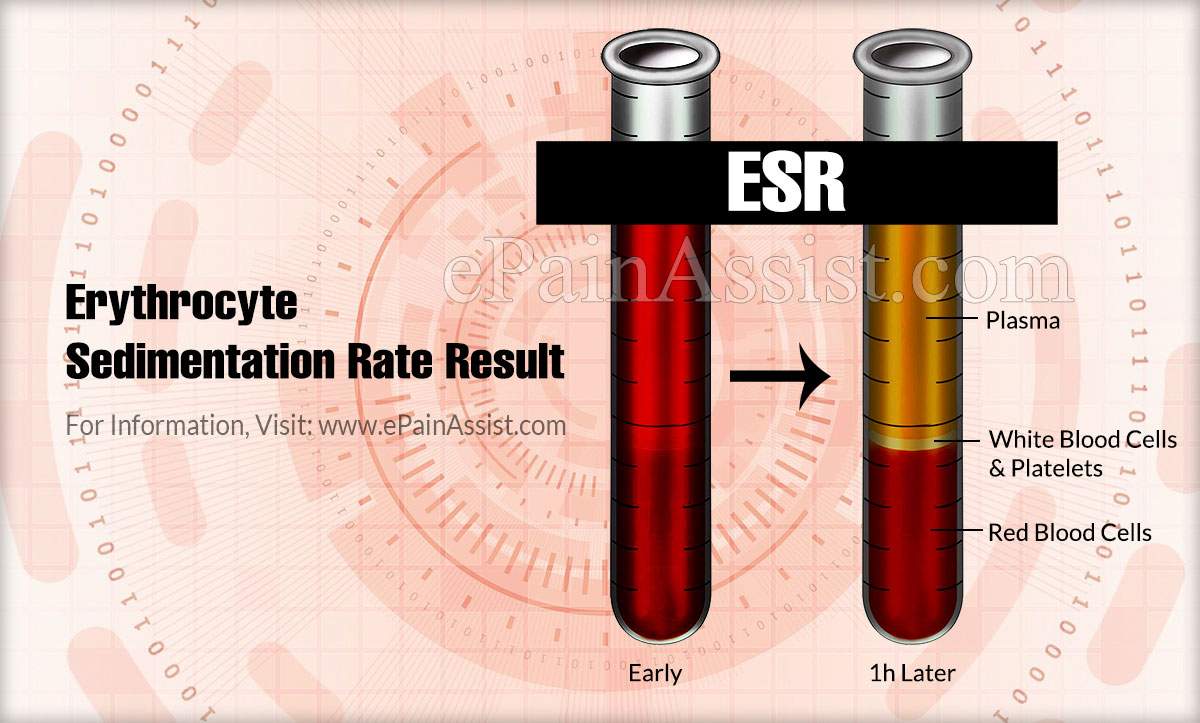 Erythrocyte Sedimentation Rate Result