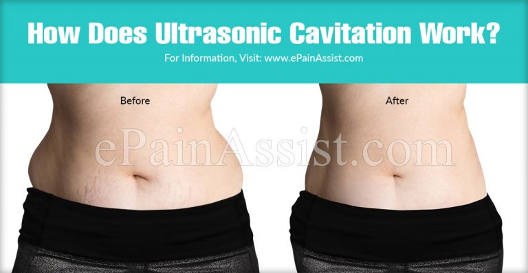 Ultrasonic Cavitation or Ultrasonic Lipolysis: Procedure & Side Effects