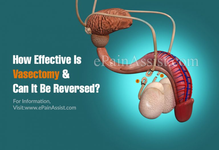 How Effective Is Vasectomy & Can It Be Reversed?