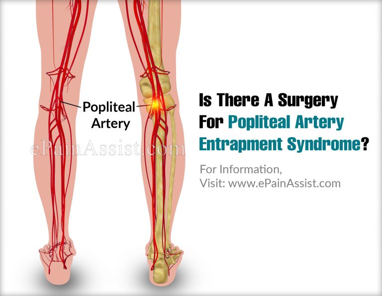Is There A Surgery For Popliteal Artery Entrapment Syndrome?