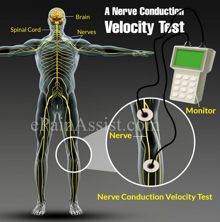 A Nerve Conduction Velocity Test: How Does It Work & What is it Used For?
