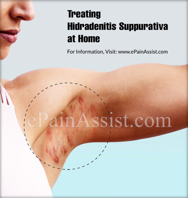 Treating Hidradenitis Suppurativa at Home