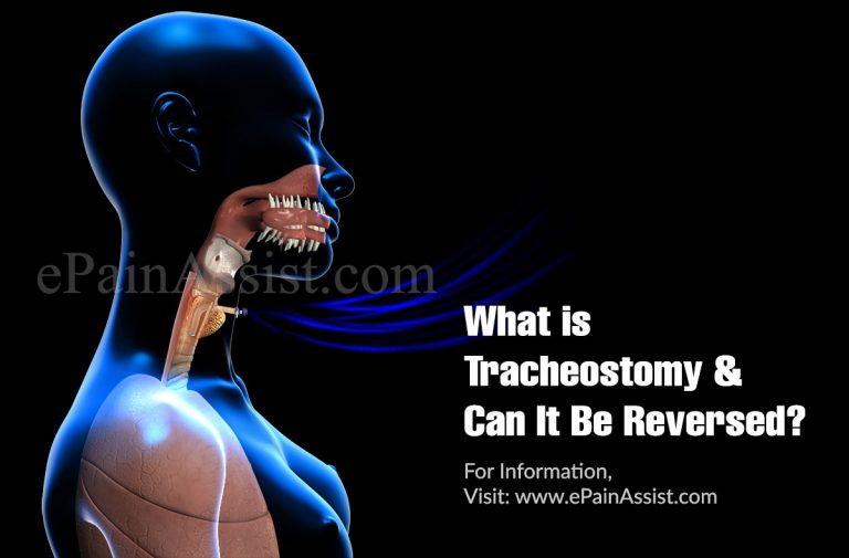 What is Tracheostomy & Can It Be Reversed?