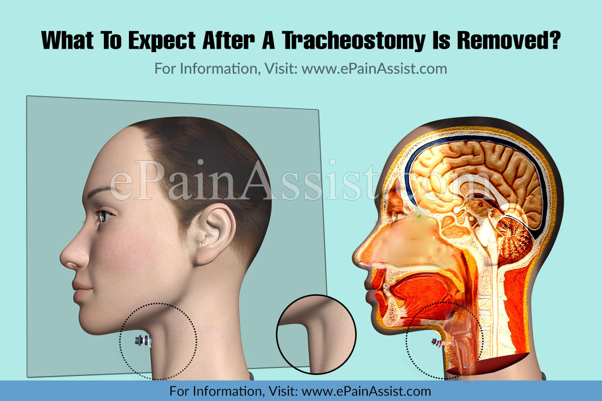 What To Expect After A Tracheostomy Is Removed?