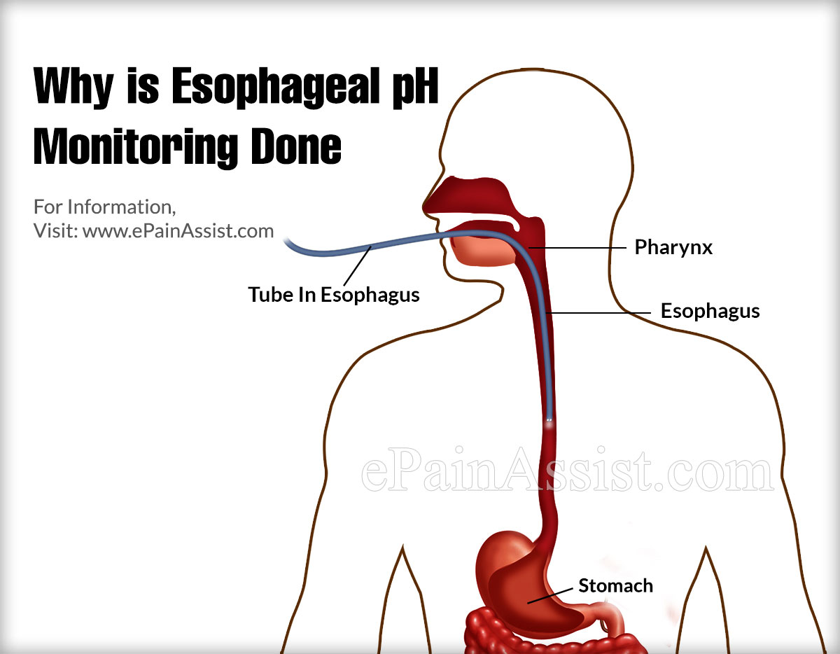 What is Esophageal pH Monitoring?