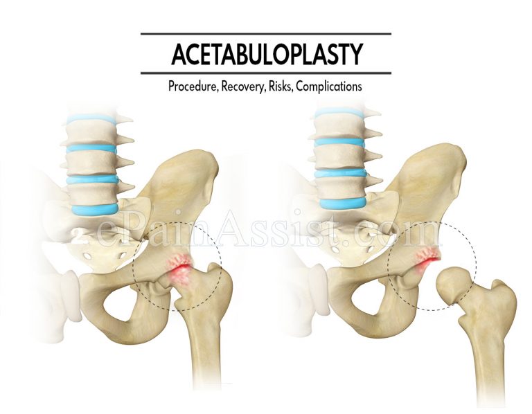 Acetabuloplasty: Procedure, Recovery, Risks, Complications
