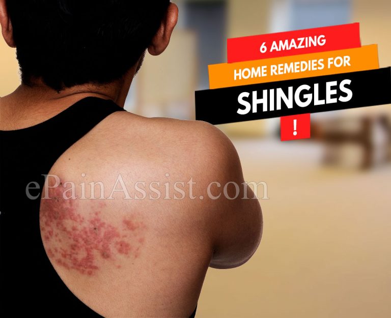 6 Amazing Home Remedies for Shingles