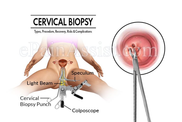 Cervical Biopsy: Types, Procedure, Recovery, Risks and Complications