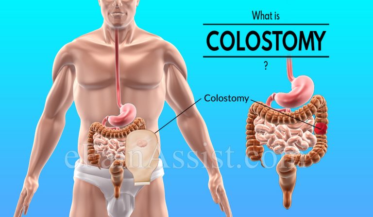 Colostomy: Why is it Performed, How is it Performed, Types of Colostomy and Its Risks