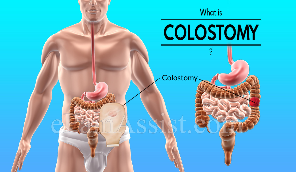 What is Colostomy? What is Colostomy?