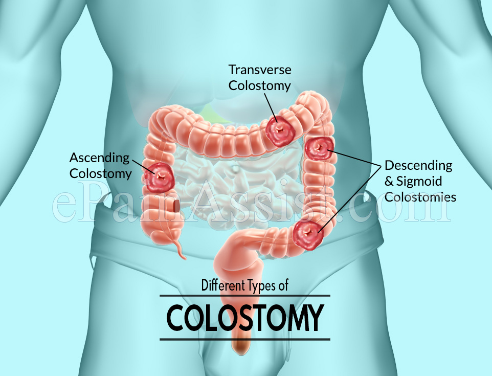 Different Types of Colostomy Different Types of Colostomy