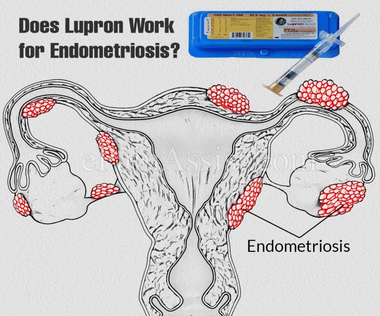 Is Lupron Effective in Treating Endometriosis and Other Endo-Related Infertility?