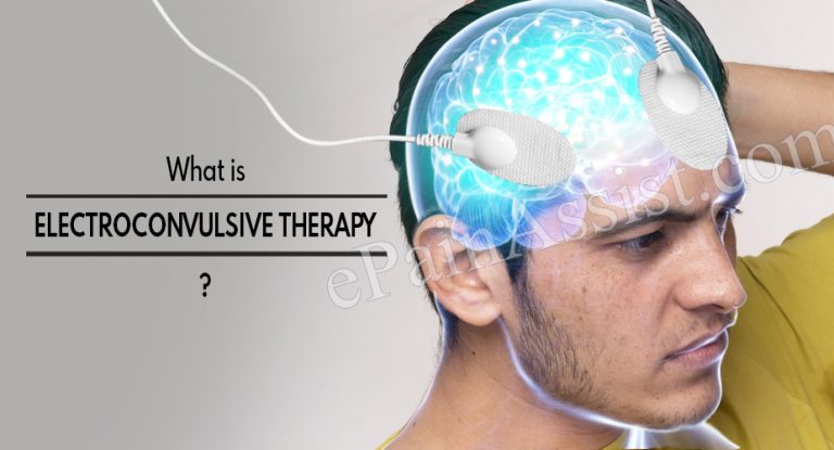 What is Electroconvulsive Therapy, How Does ECT Work, Procedure, Benefits and Side Effects