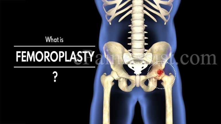 Femoroplasty:  When Do you Need Femoroplasty, How is it Performed, Its Risks, Complications and Recovery Period