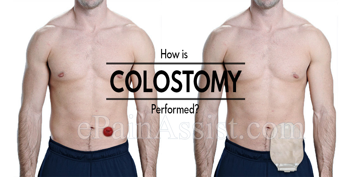 How is Colostomy Performed? How is Colostomy Performed?