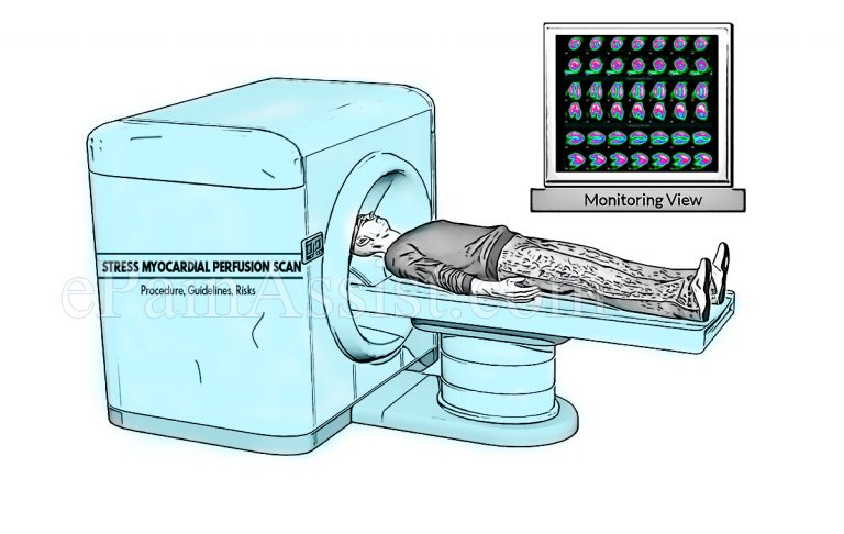 What is a Stress Myocardial Perfusion Scan (Stress MPI), Procedure, Guidelines, Risks