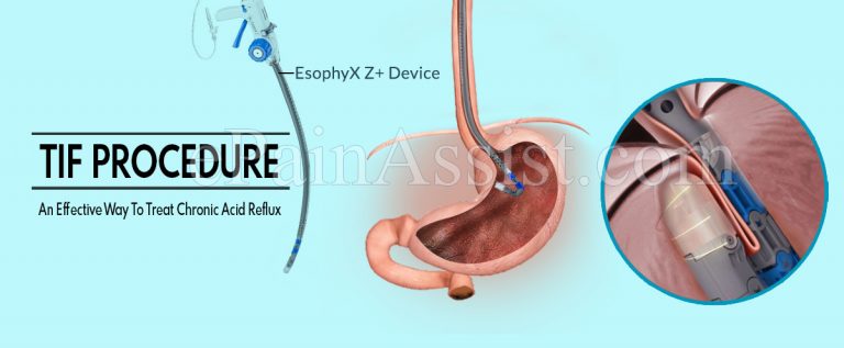 TIF Procedure: An Effective Way To Treat Chronic Acid Reflux