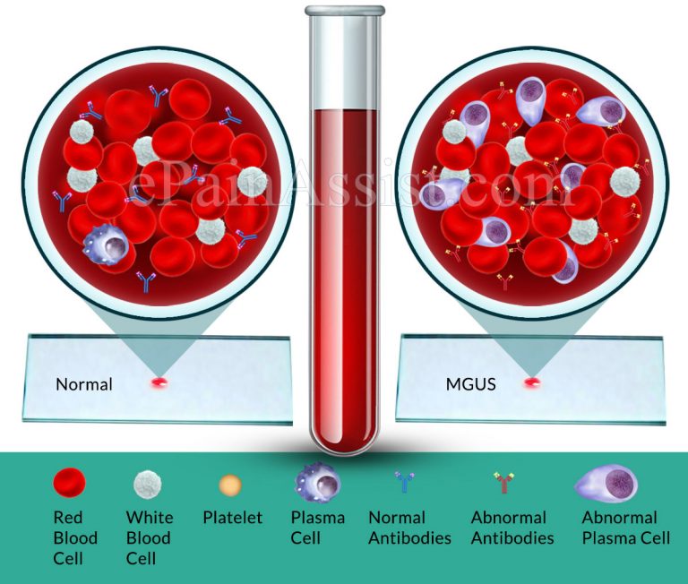 What Is The Best Treatment For MGUS Or Monoclonal Gammopathy Of Undetermined Significance?