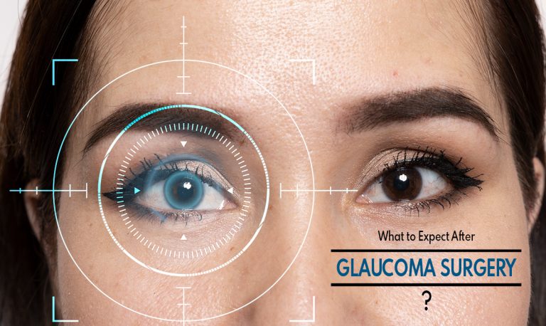 What to Expect After Glaucoma Surgery?