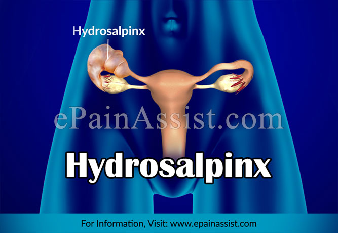 What is Hydrosalpinx?