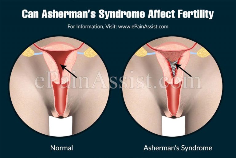 Asherman’s Syndrome: Stages, Causes, Symptoms, Treatment, Can Asherman’s Syndrome Cause Miscarriage?