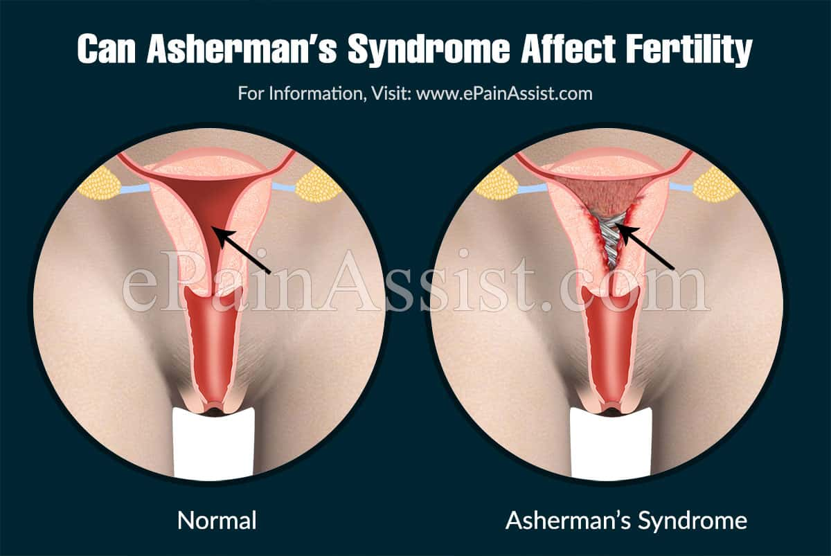 Can Asherman’s Syndrome Affect Fertility