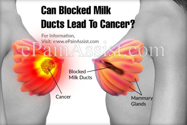 Can Blocked Milk Ducts Lead To Cancer?