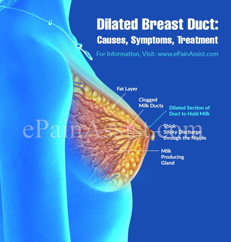 Dilated Breast Duct: It’s Causes, Symptoms, Treatment