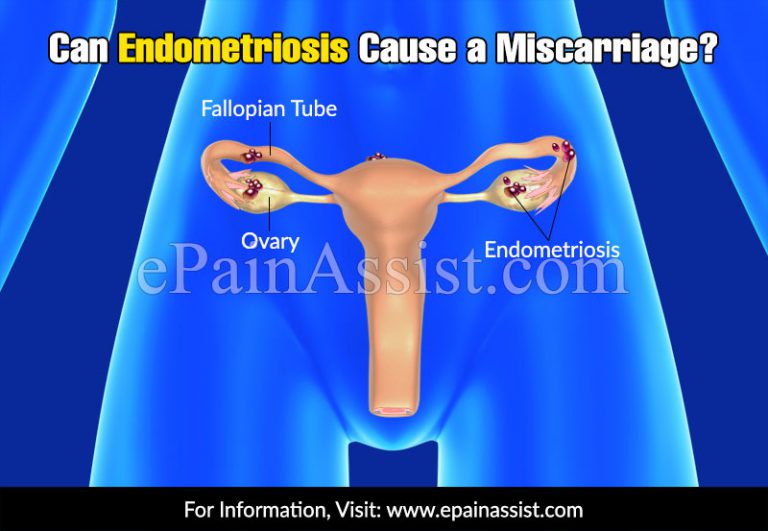 Endometriosis and Miscarriage: Can Endometriosis Cause a Miscarriage?