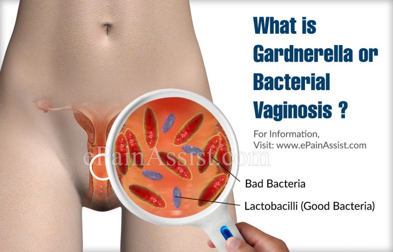 Gardnerella or Bacterial Vaginosis: Causes, Symptoms, Treatment, Home Remedies, Prevention