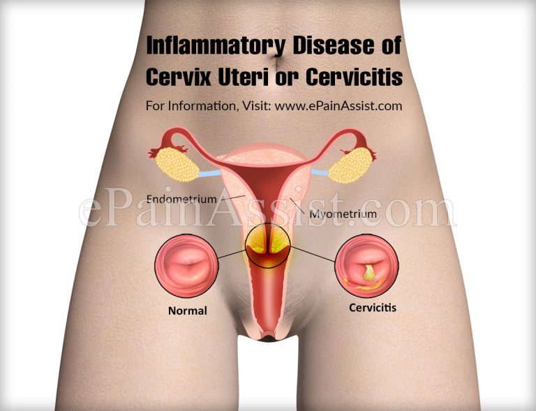 Inflammatory Disease of Cervix Uteri or Cervicitis: Causes, Symptoms, Treatment, Risk Factors, Prevention