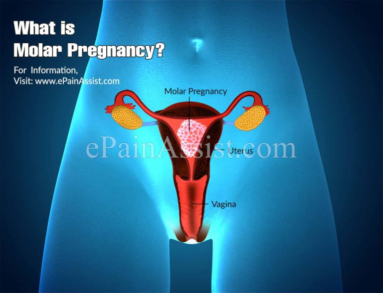 Molar Pregnancy: Types, Risk Factors, Symptoms, Treatment, Complications