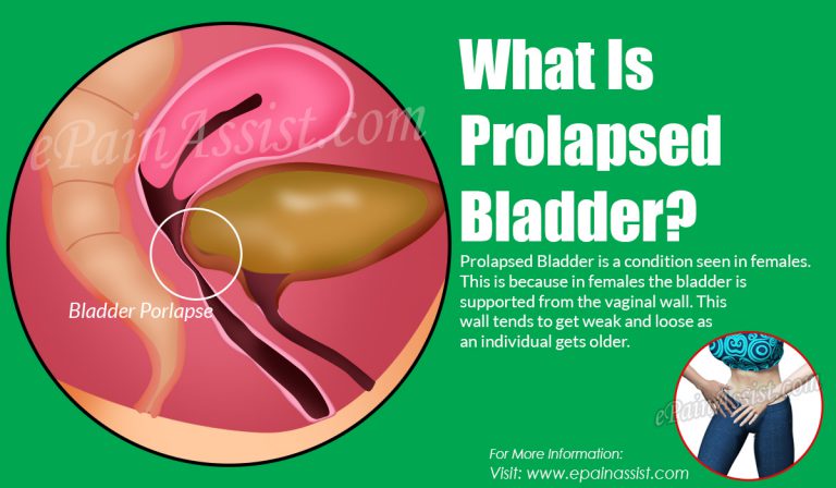 Prolapsed Bladder: Stages, Causes, Symptoms, Treatment & Surgery