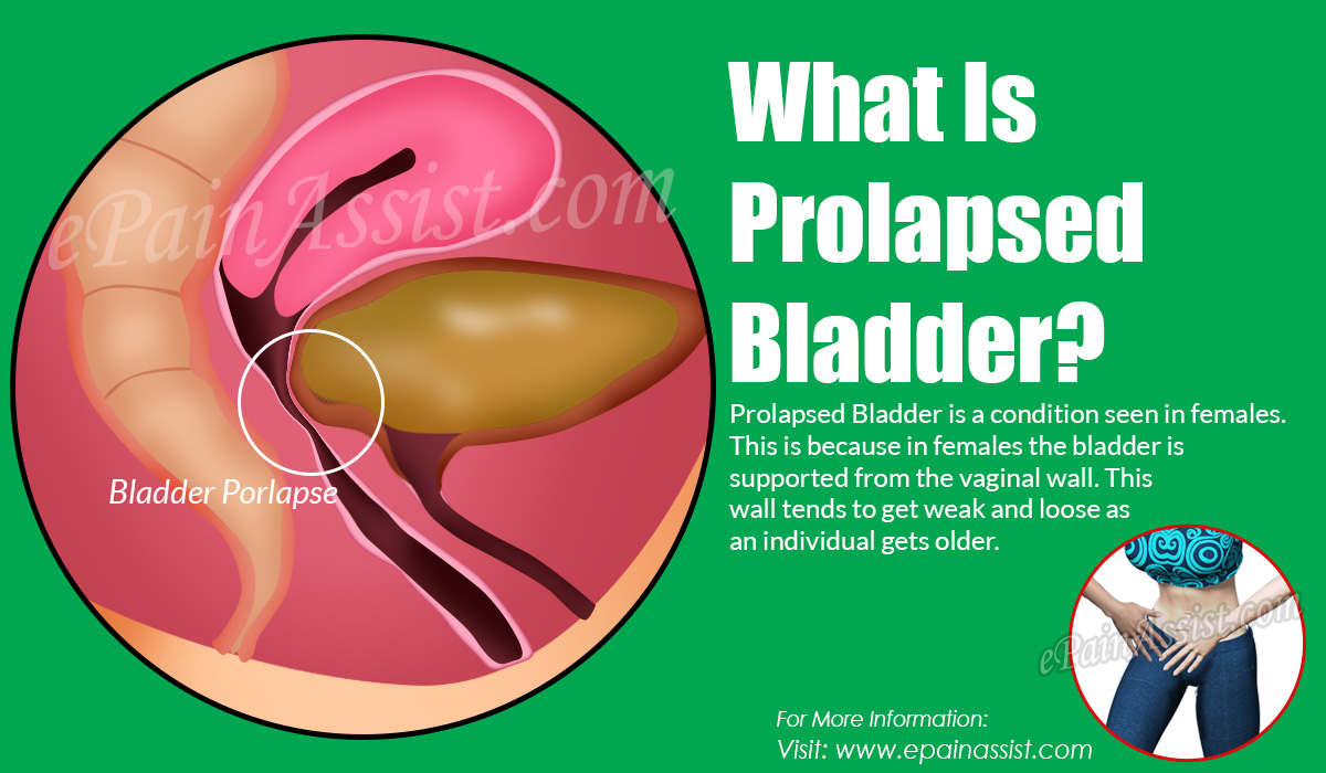 What Is Prolapsed Bladder?