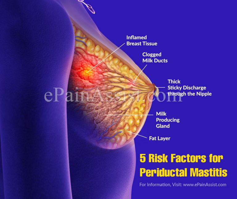 5 Risk Factors for Periductal Mastitis