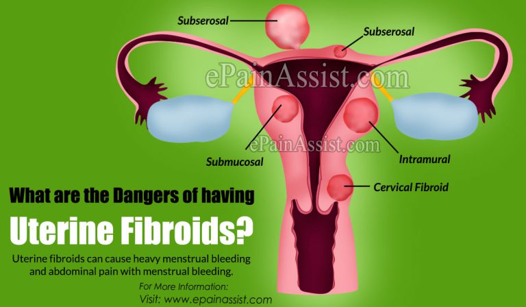 What Are The Dangers Of Having Uterine Fibroids?