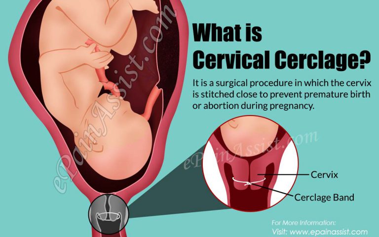 What is Cervical Cerclage?