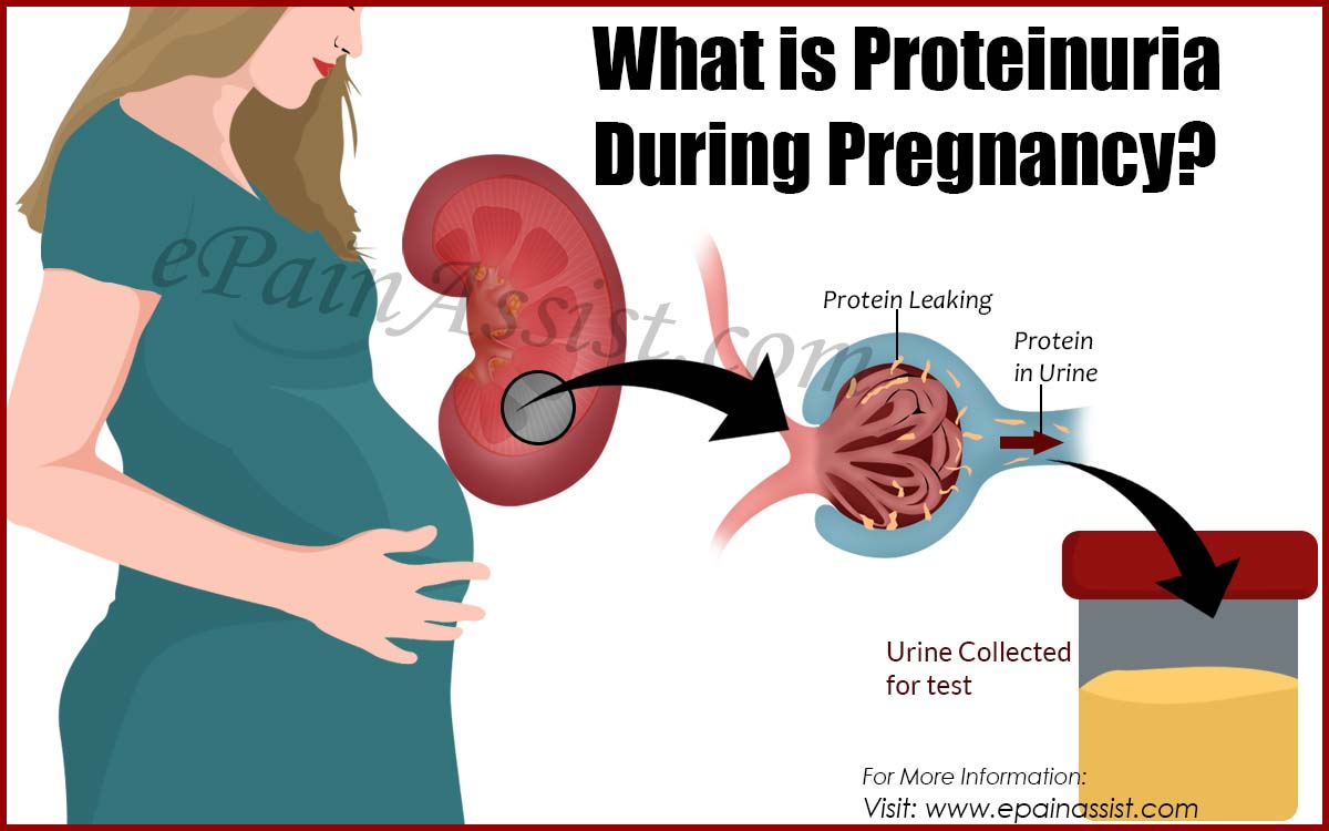 What is Proteinuria During Pregnancy?