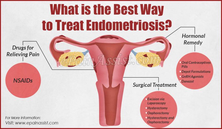 What is the Best Way to Treat Endometriosis?