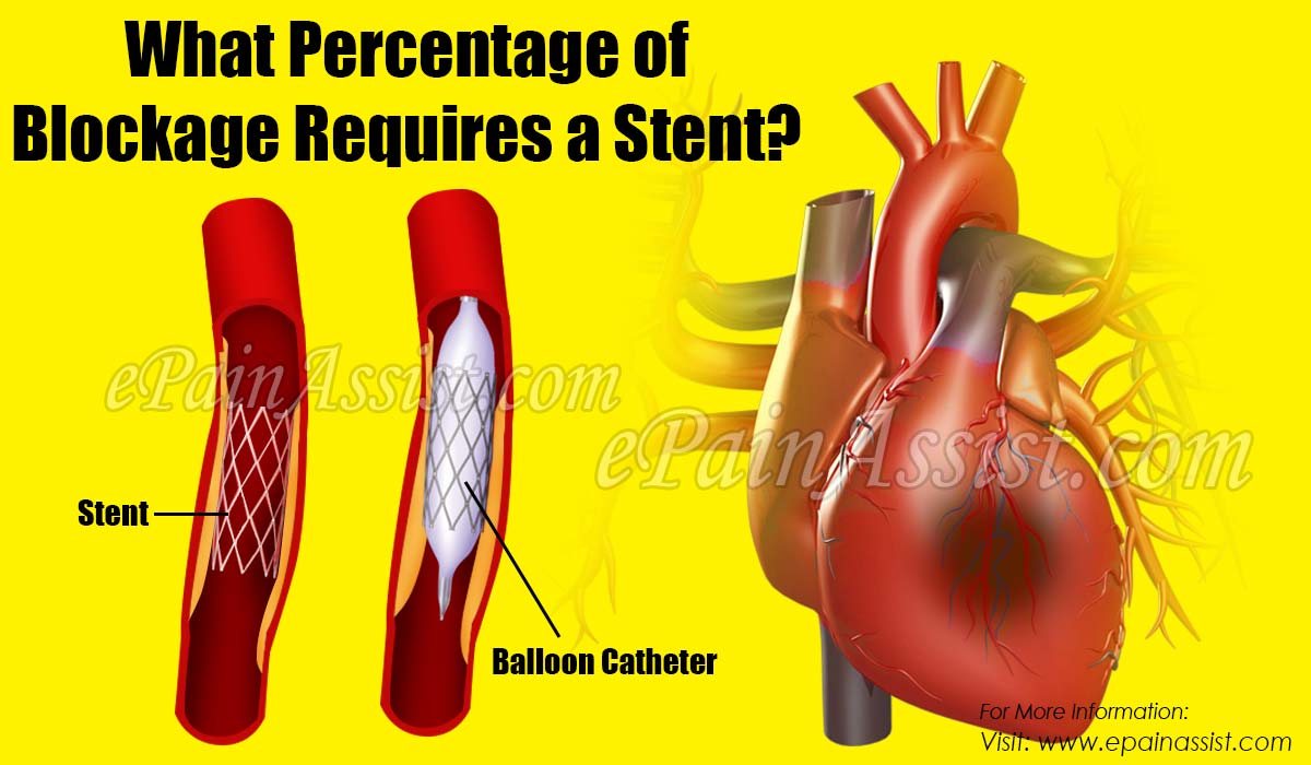 What Percentage of Blockage Requires a Stent?